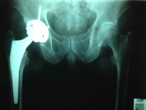 new hip x-ray